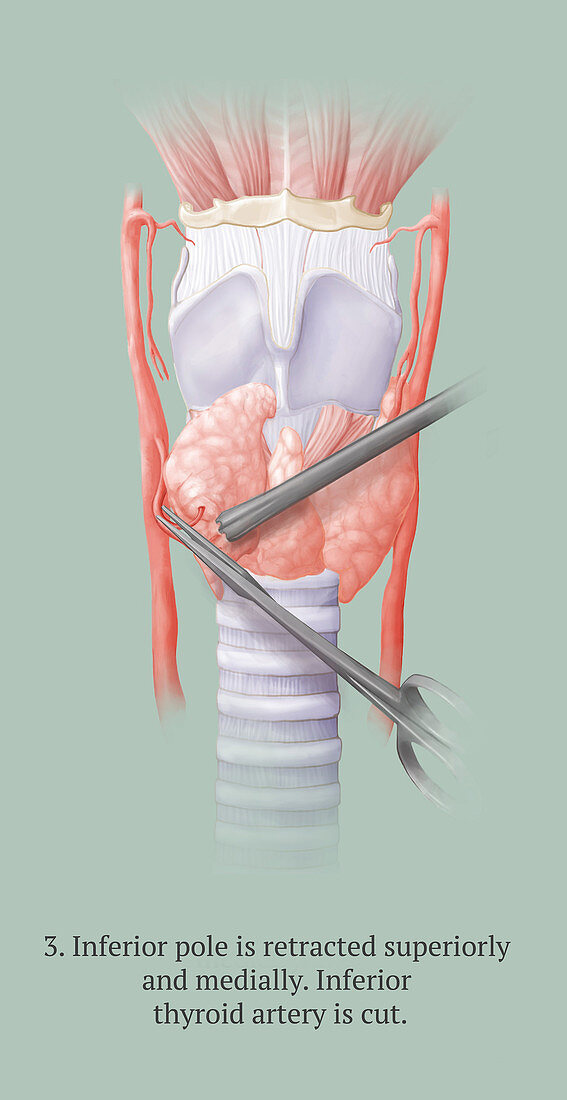 Thyroidectomy, 3 of 5