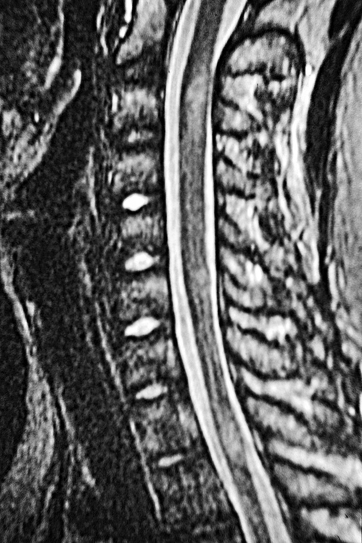 Medullary Ischemia, MRI