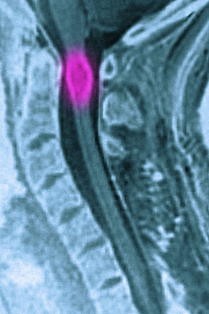 Neuroma on spinal cord, MRI