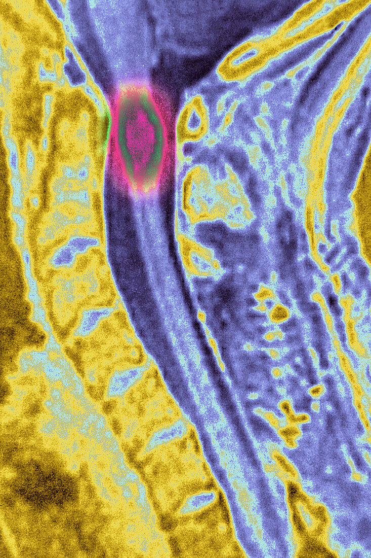 Neuroma on spinal cord, MRI