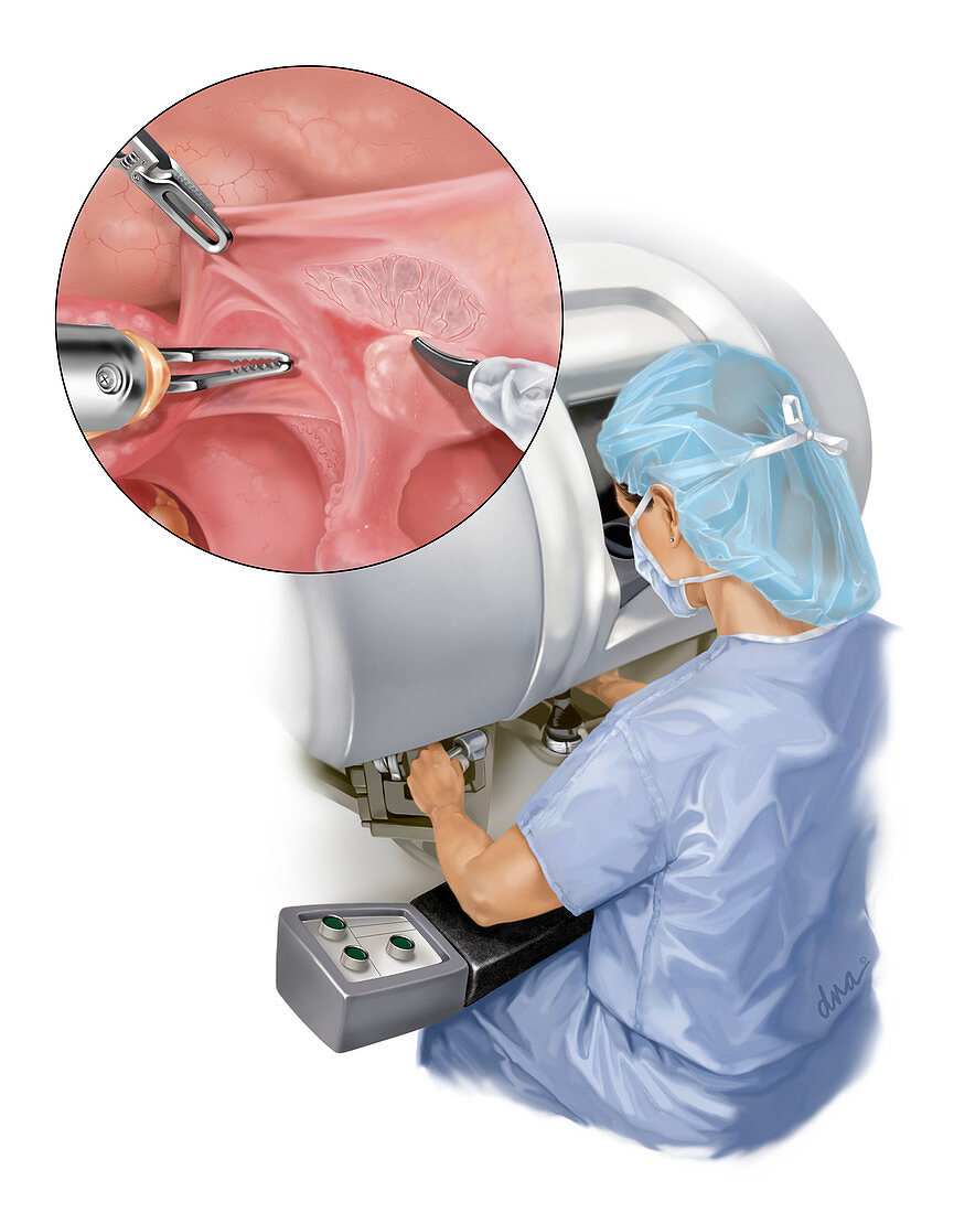 Robotic Hysterectomy