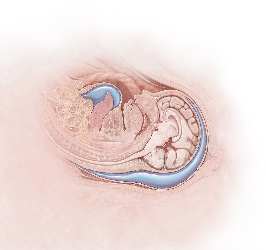 Foetal Hydrops