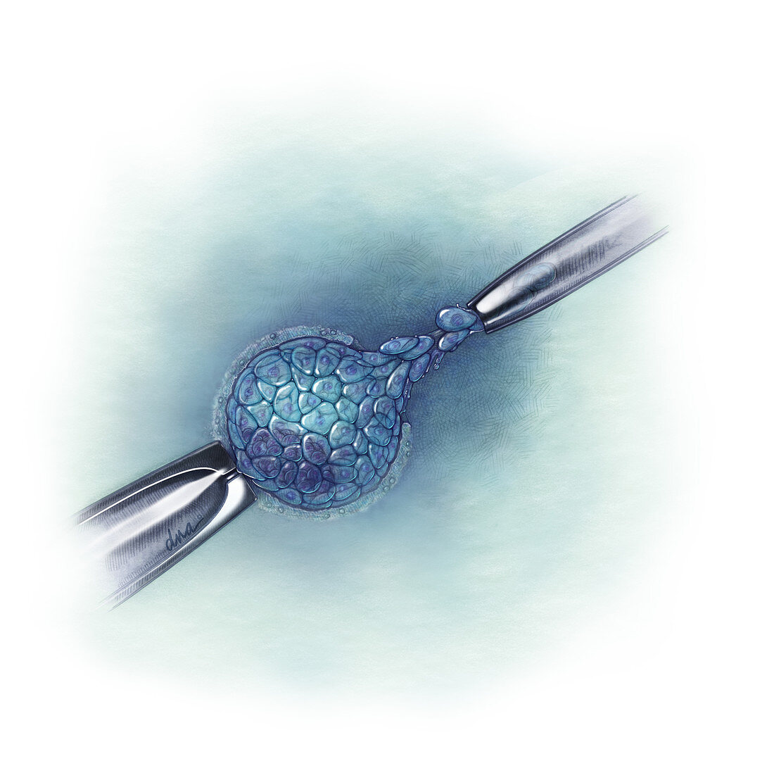 Euploid Single Embryo Transfer