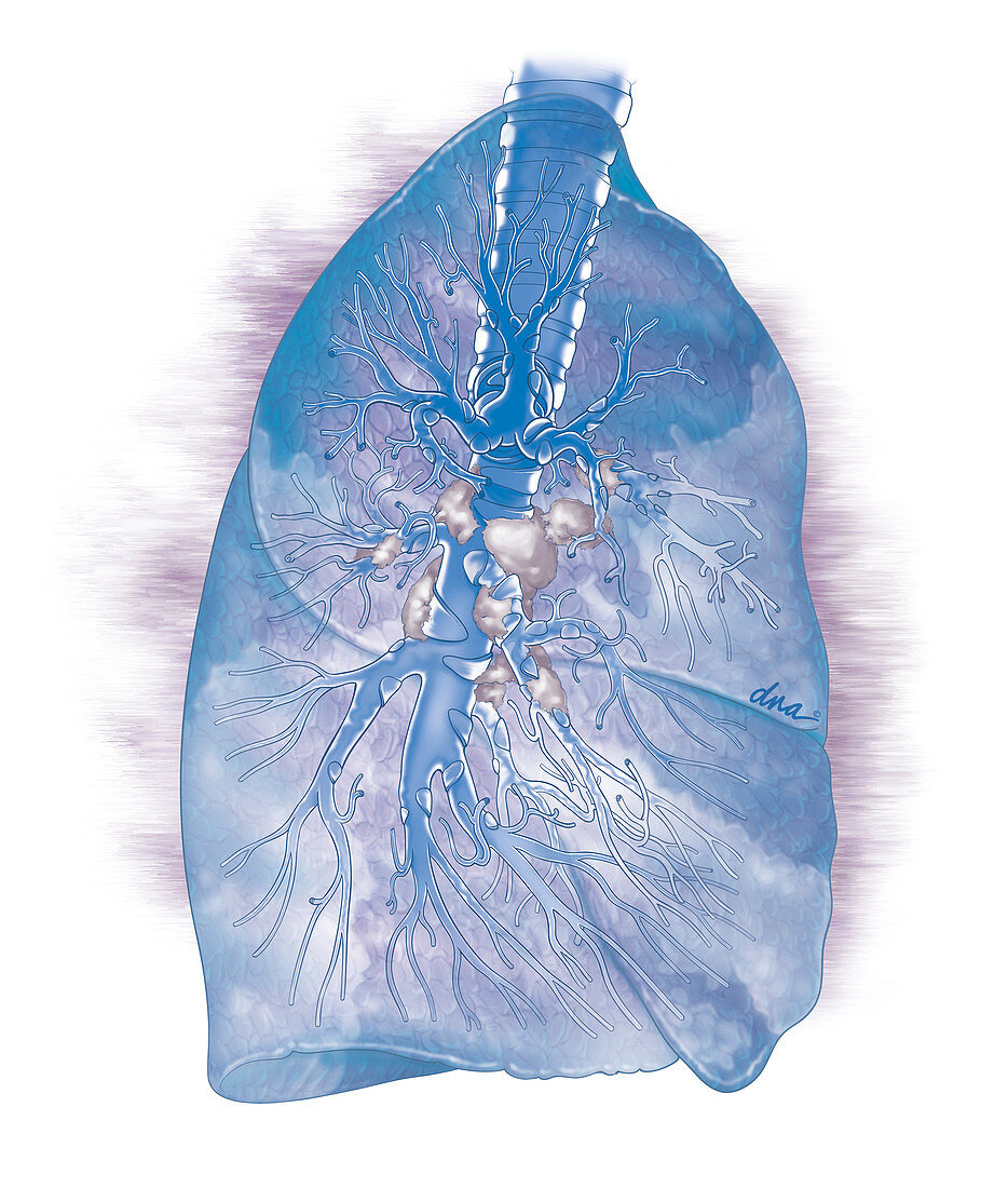 Breathlessness with Lung Cancer