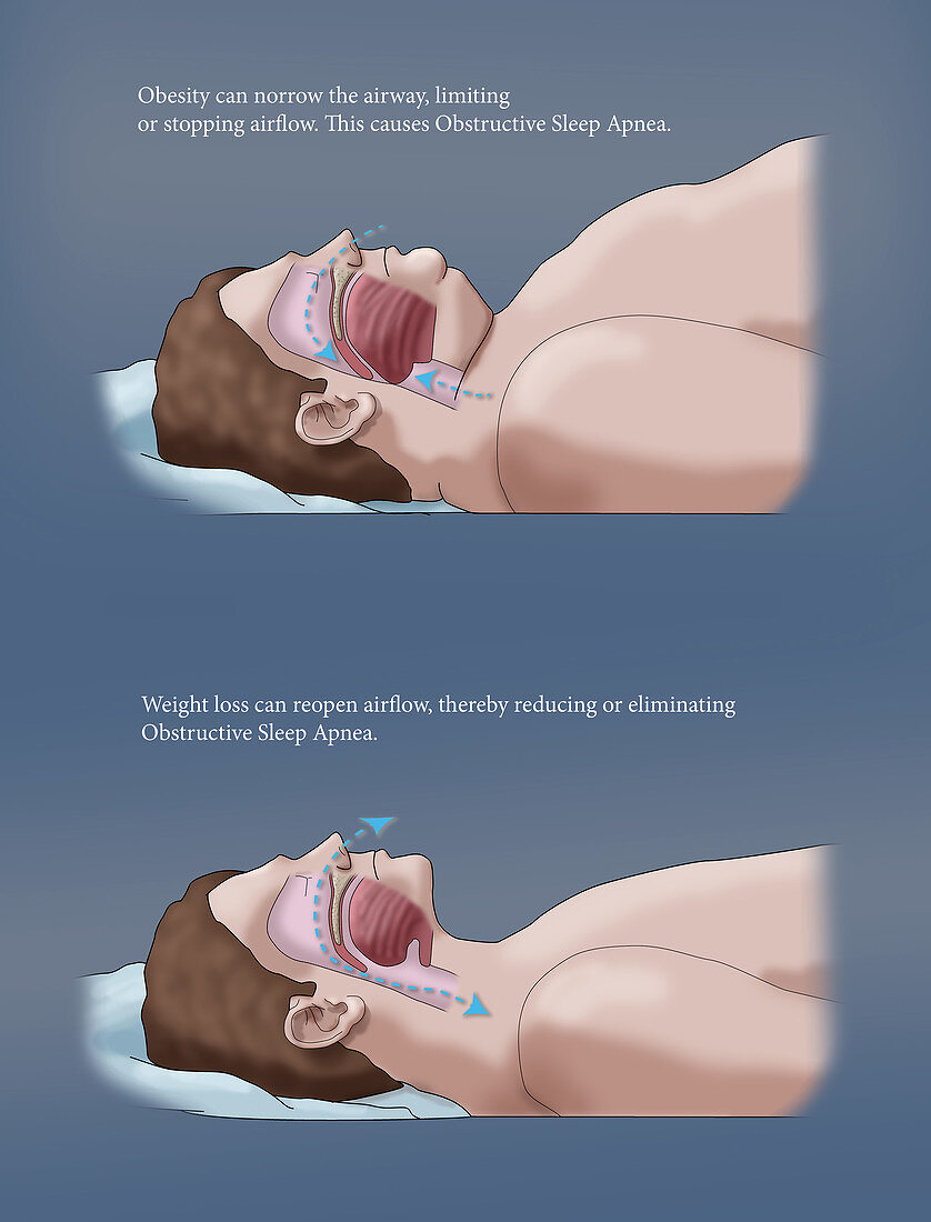 Obesity and Sleep Apnea, Illustration