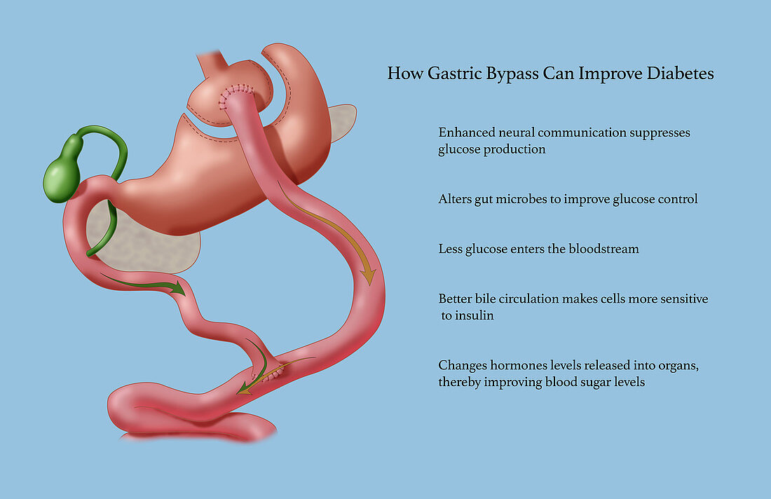 Gastric Surgery for Diabetes