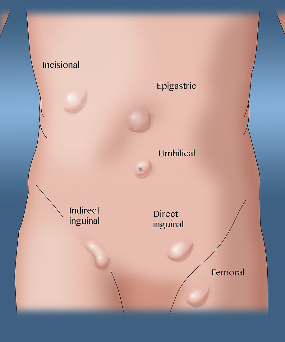 Types of Hernias, Illustration