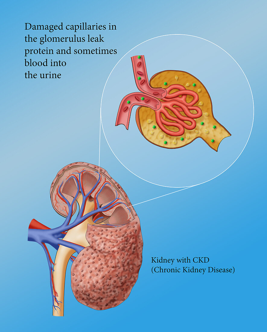 Chronic Kidney Disease and Glomerulus