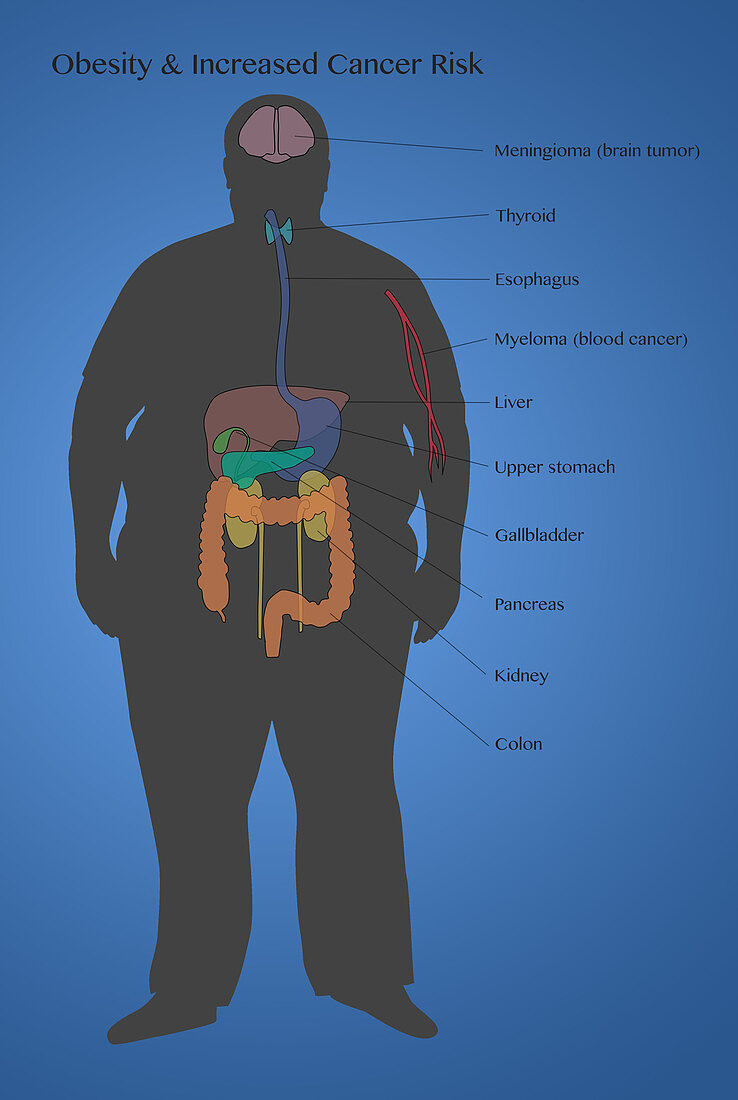 Cancer Risks of Obesity, Illustration