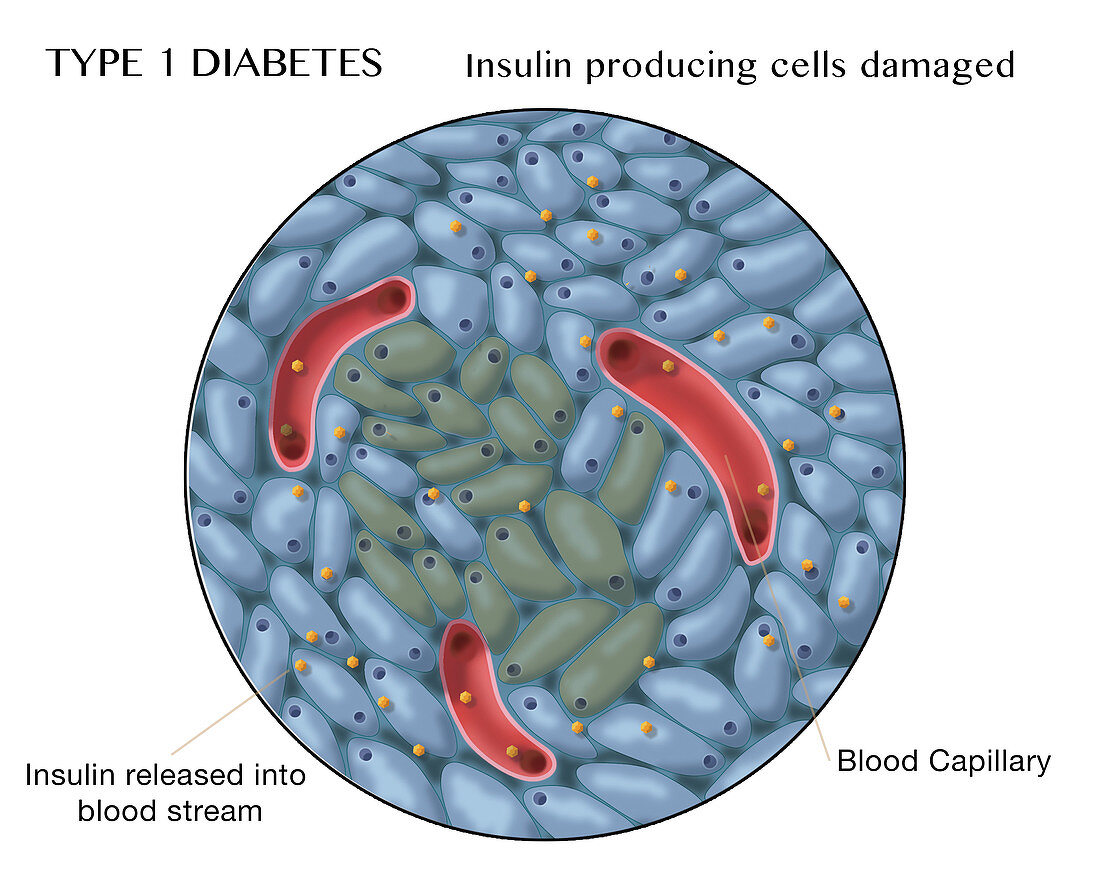 Type 1 Diabetes, Damaged Islets of Langerhans Cells