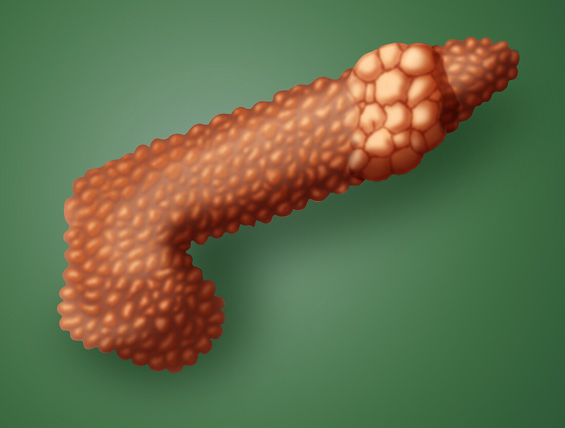 Pancreatic Cancer, Illustration