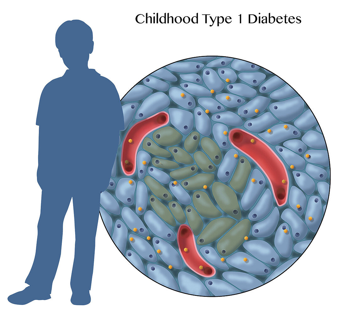 Type 1 Diabetes in Childhood