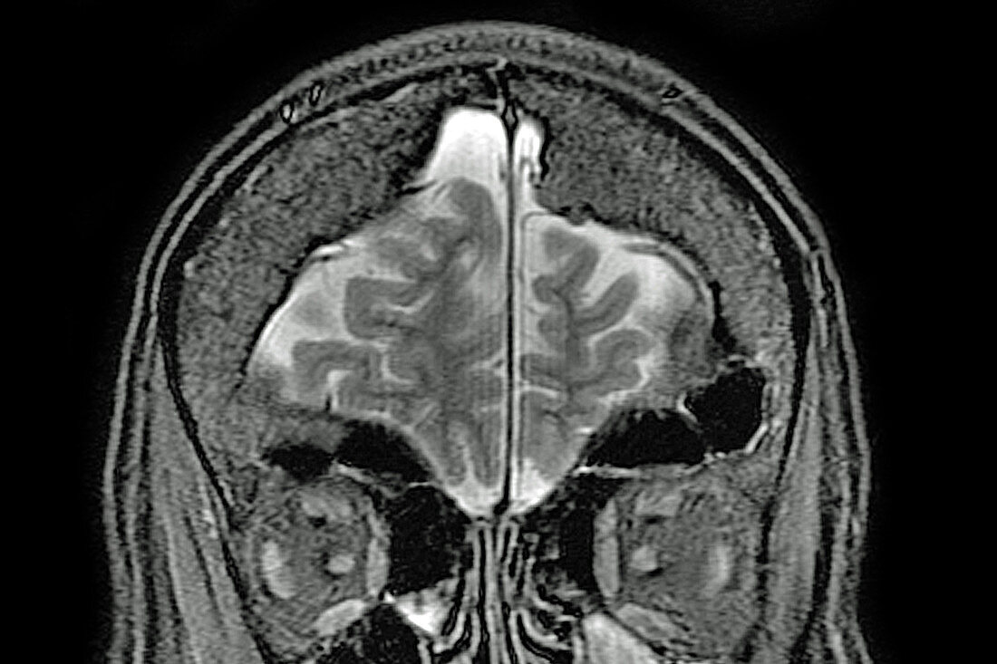 Cerebral atrophy, MRI