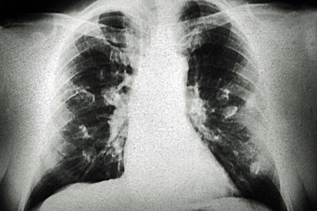 Lung Cancer, X-ray