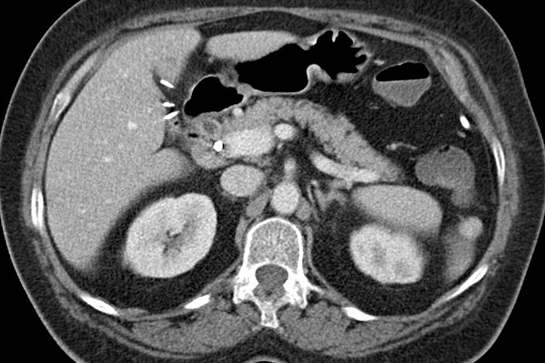 Pancreas, normal x-ray