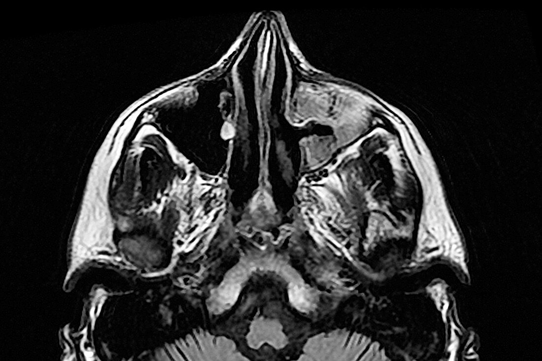 Maxillary sinusitis, MRI