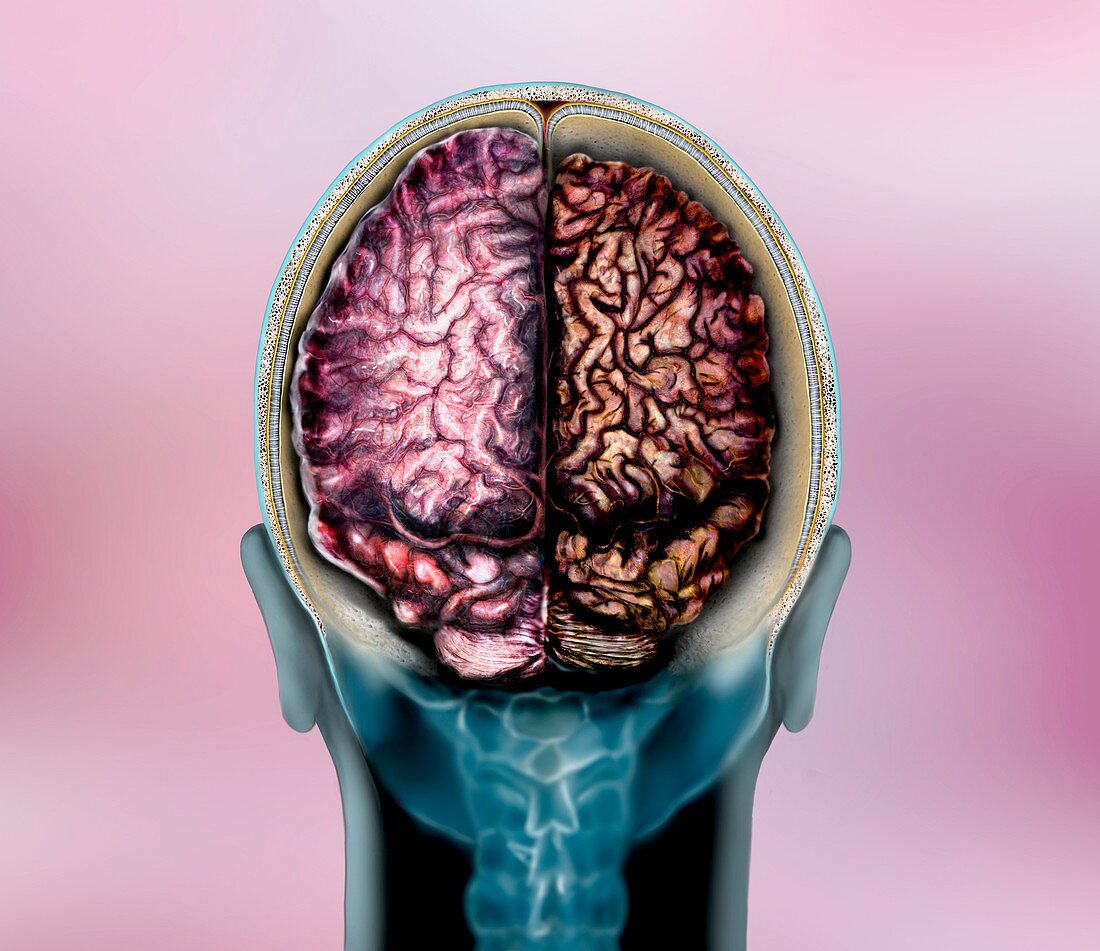 Brain in Alzheimer's disease, illustration