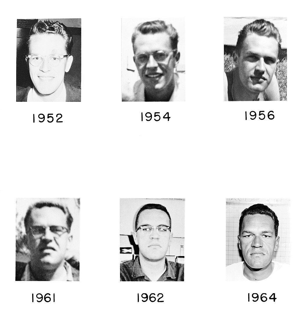 Acromegaly progression, 1952-1964
