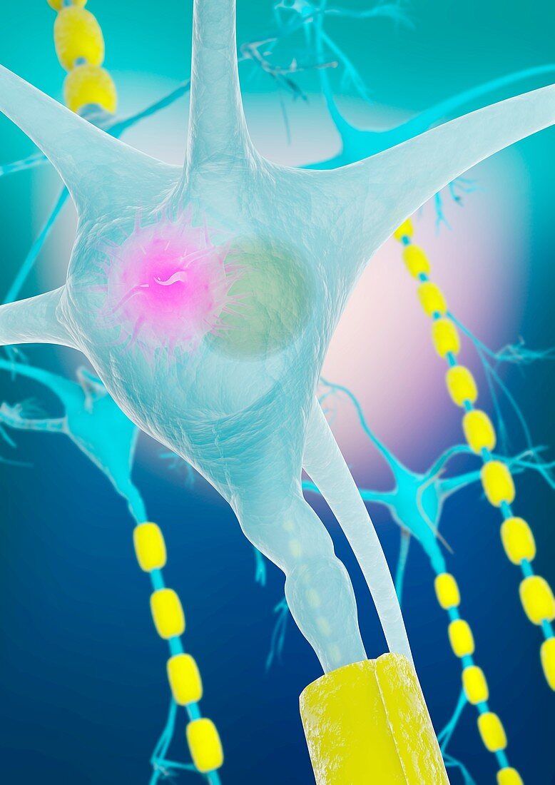 Lewy body in neuron in Parkinson's disease, illustration