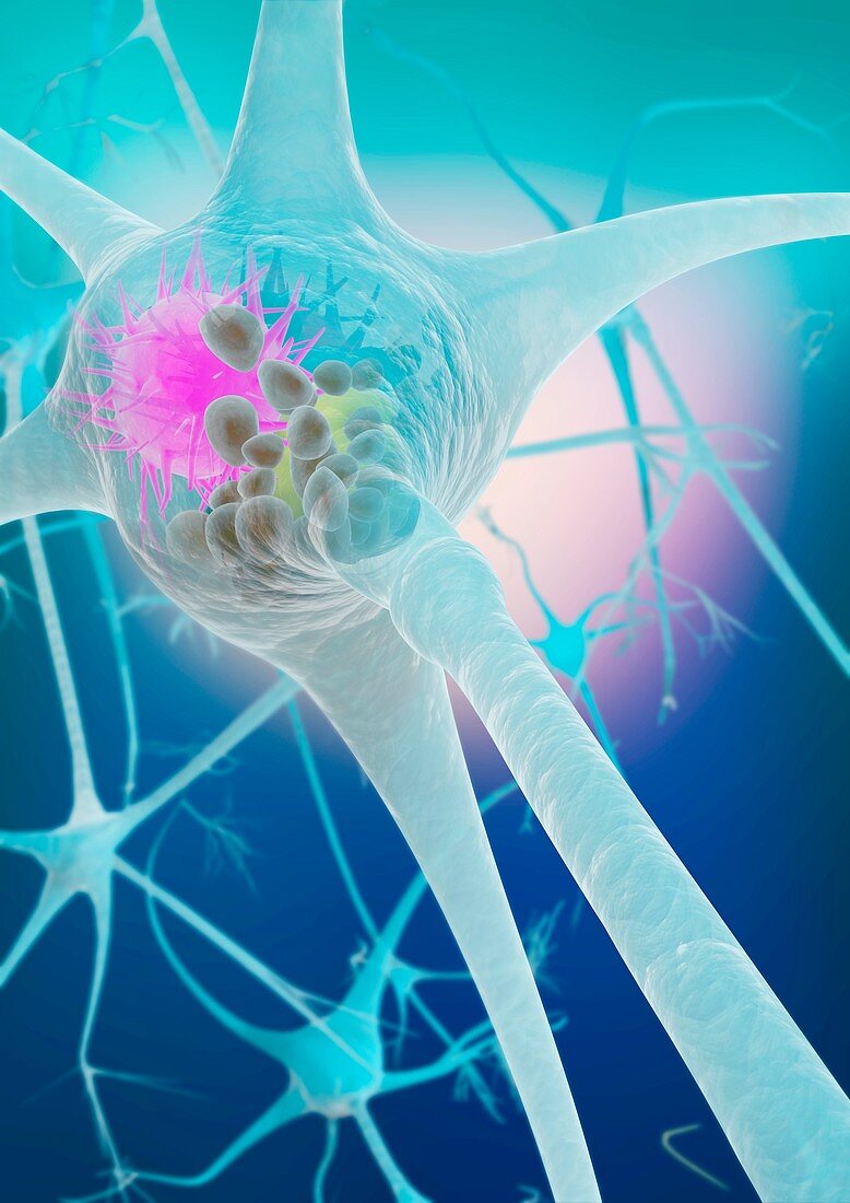 Lewy body in neuron in Parkinson's disease, illustration