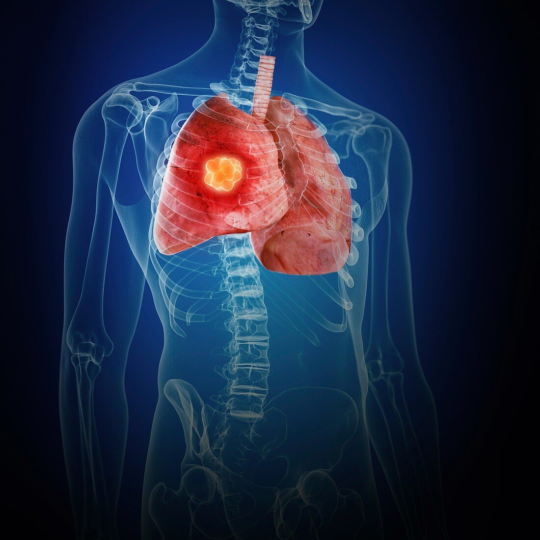 Illustration of lung cancer