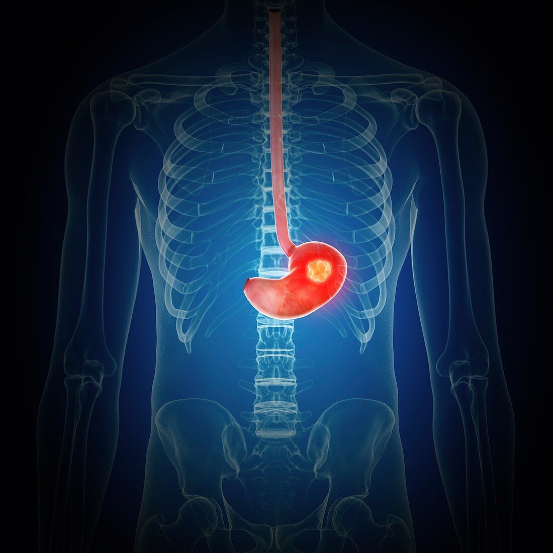 Illustration of stomach cancer