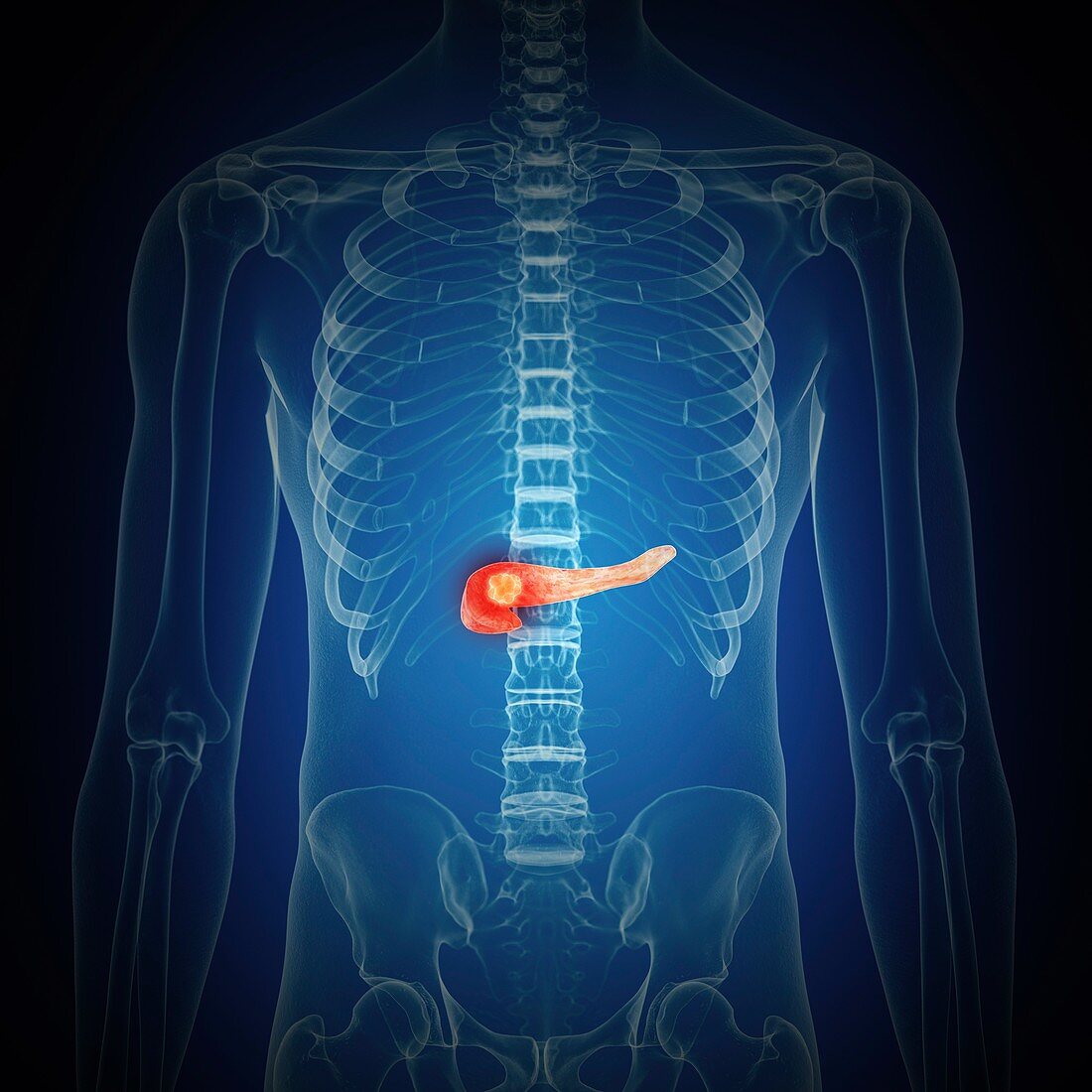 Illustration of pancreas cancer