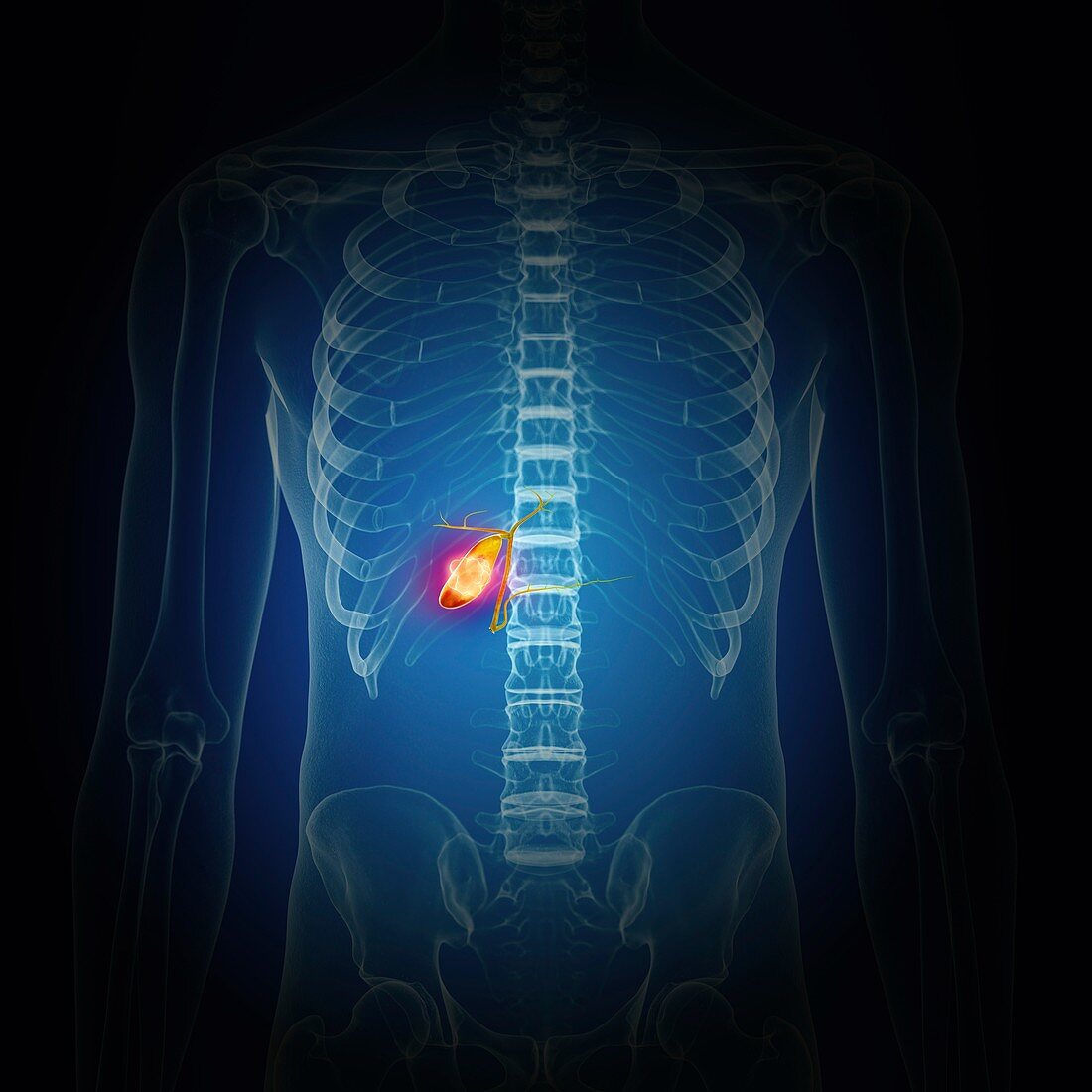 Illustration of gallbladder cancer