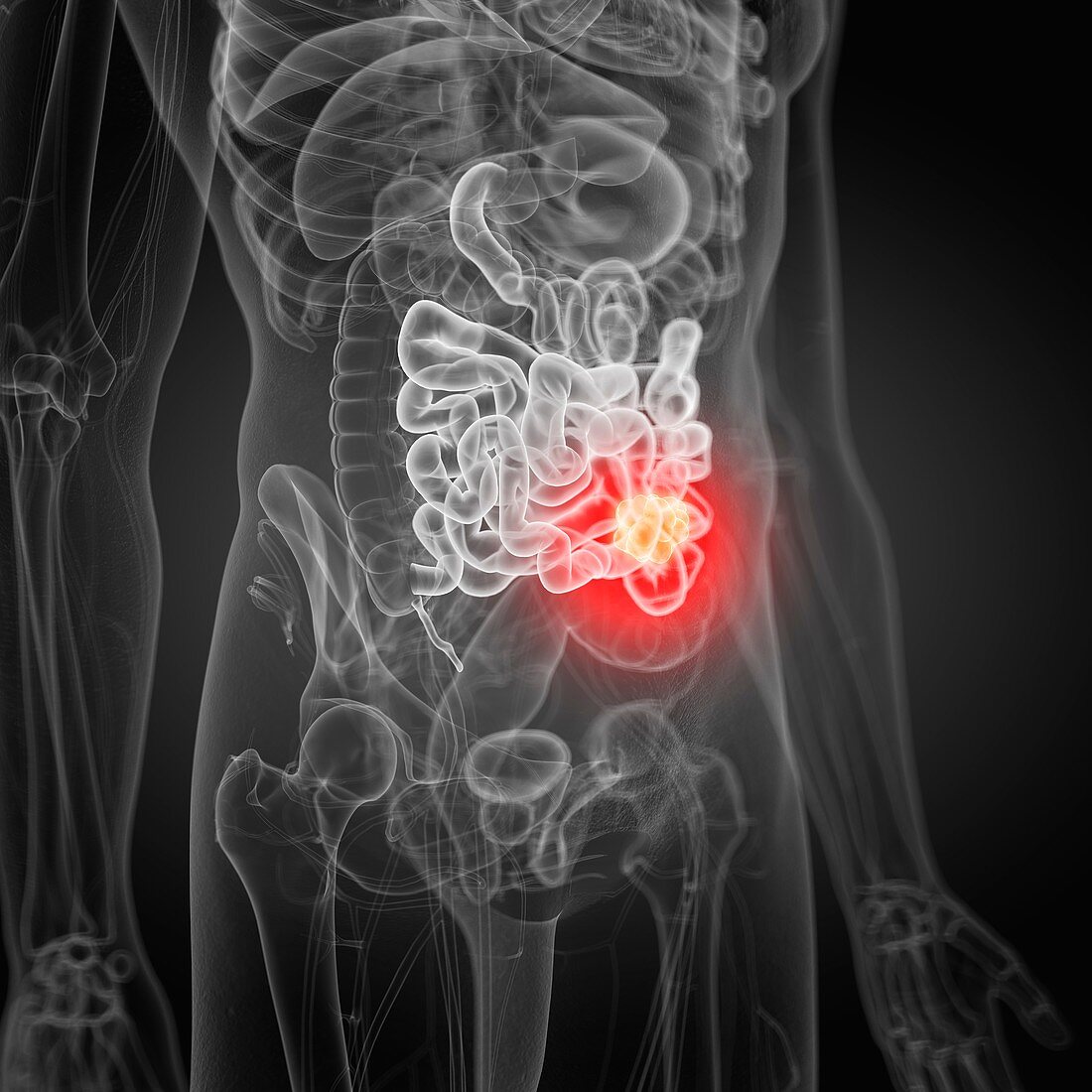 Illustration of small intestine cancer