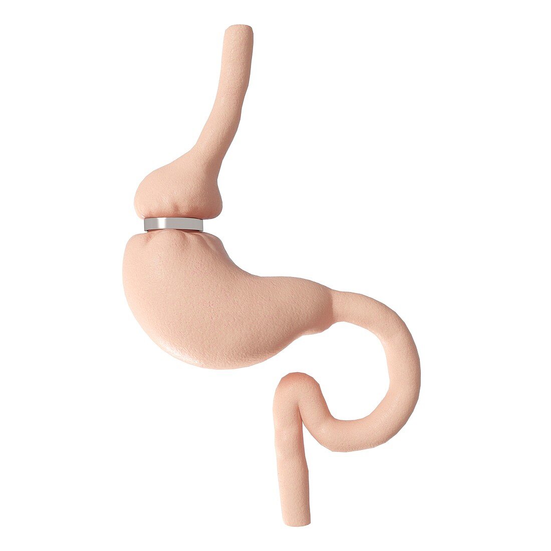 Illustration of gastric banding