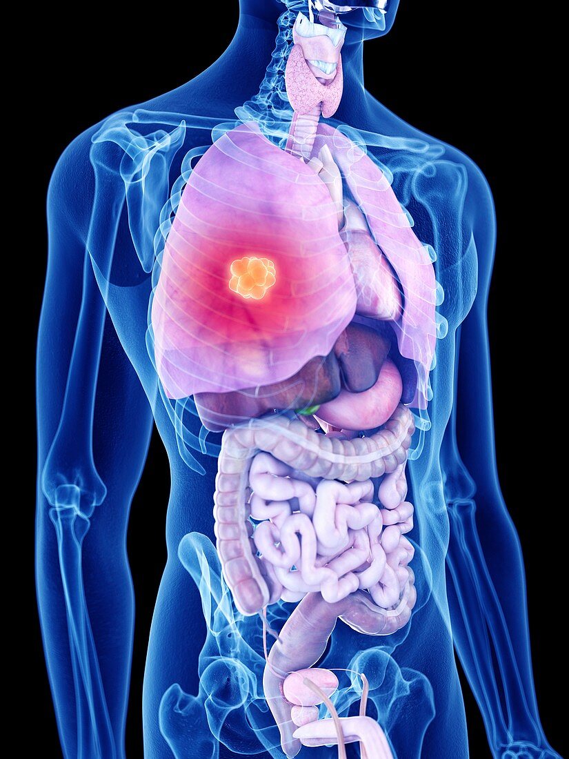 Illustration of lung cancer