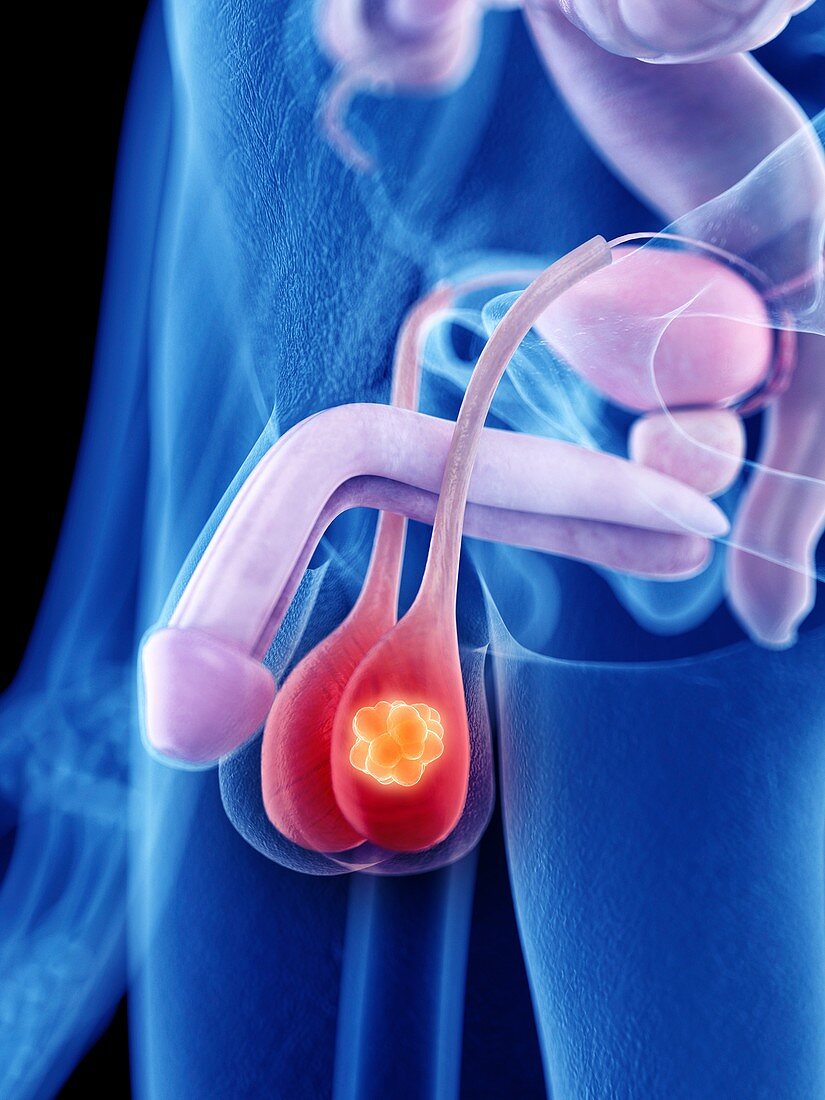 Illustration of testicle cancer