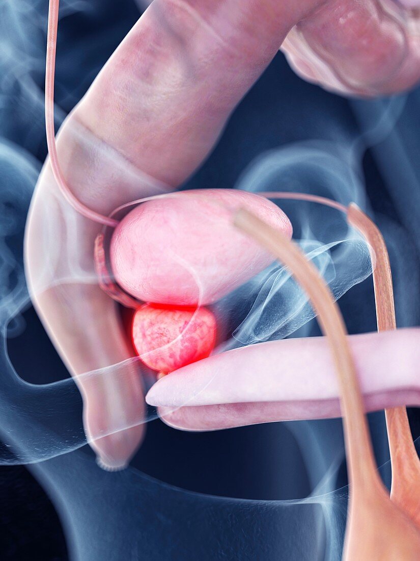 Illustration of an inflamed pancreas