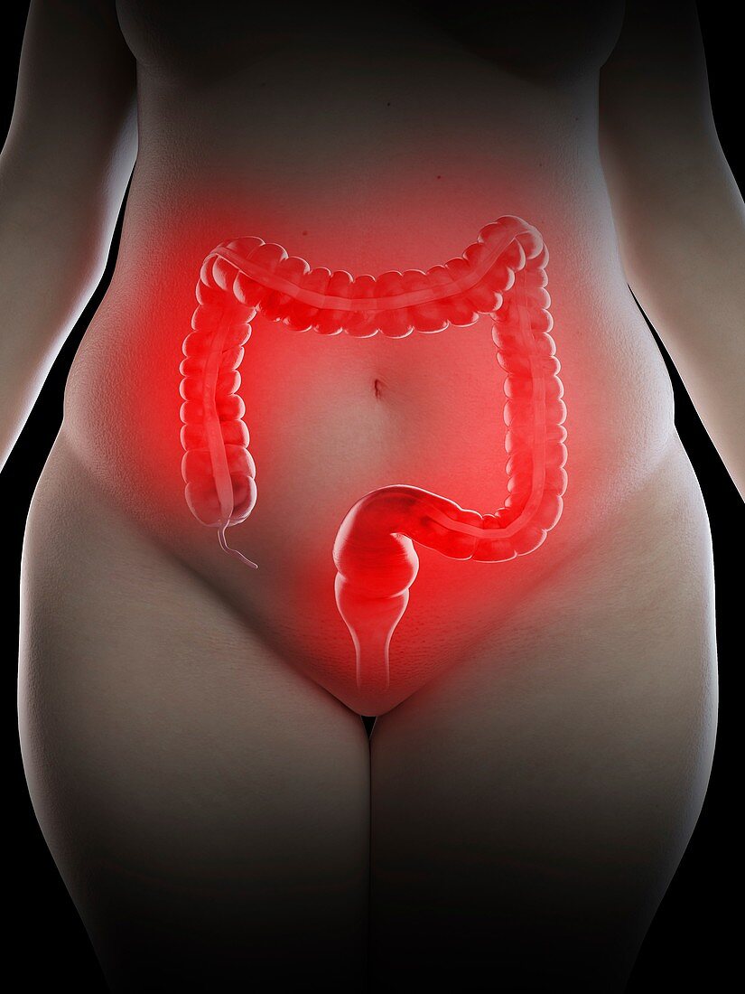 Illustration of an obese woman's inflamed colon