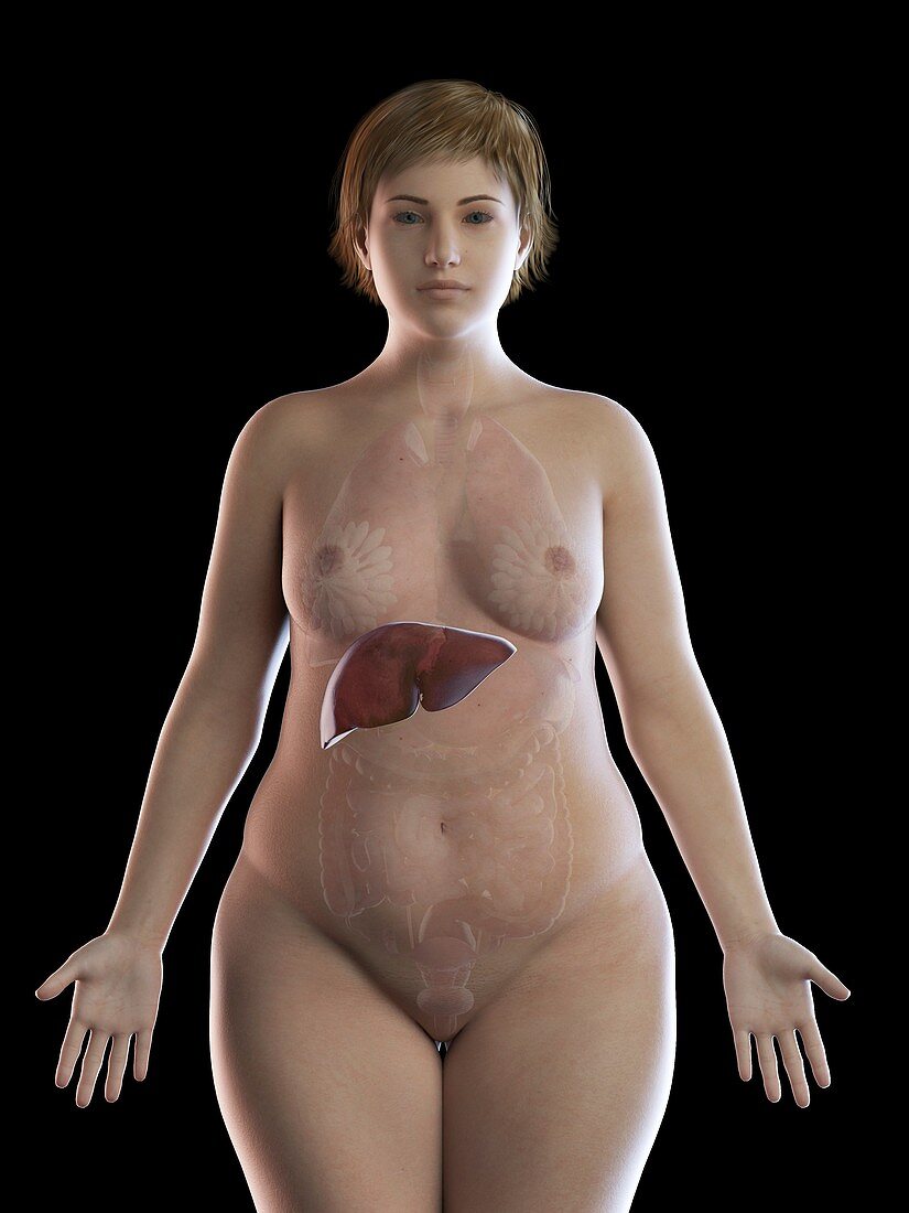 Illustration of an obese woman's liver