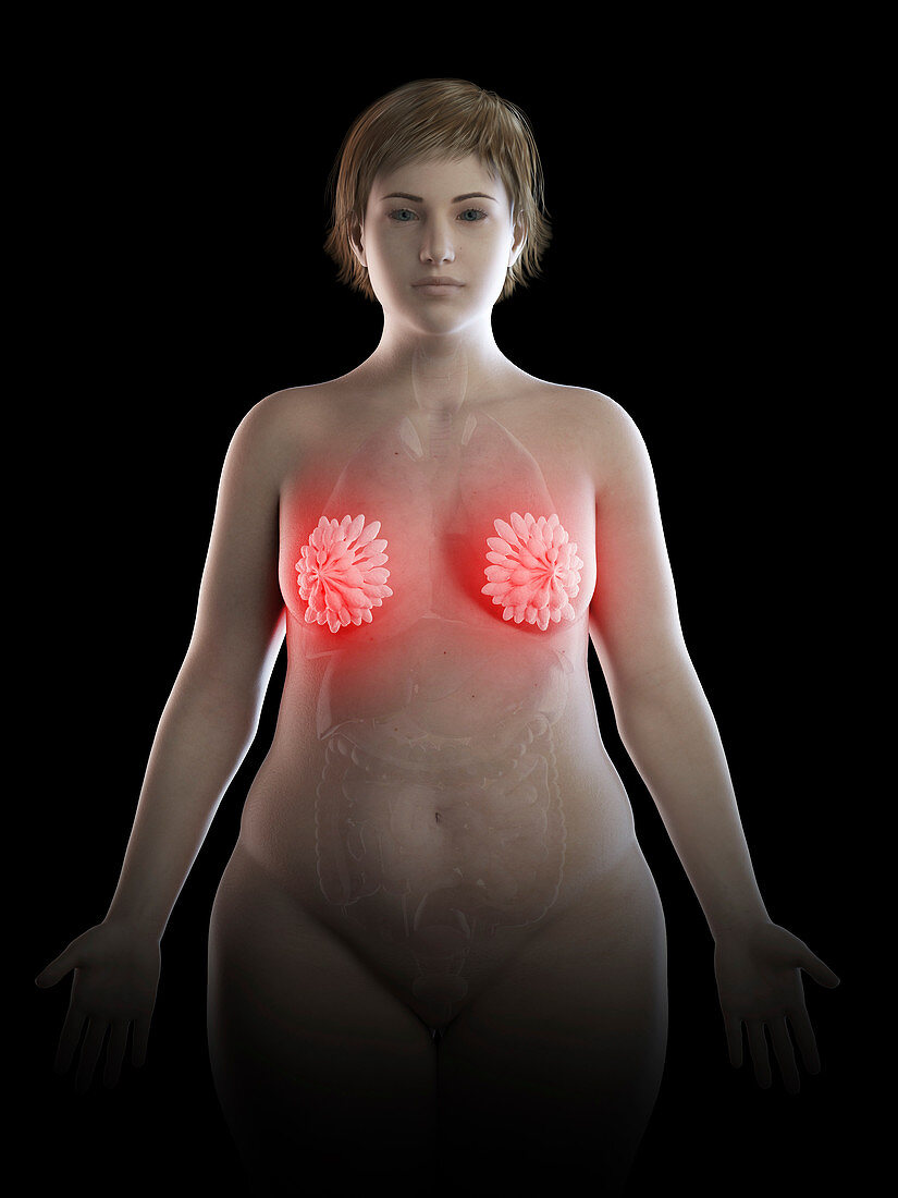 Illustration of an obese woman's inflamed mammary glands