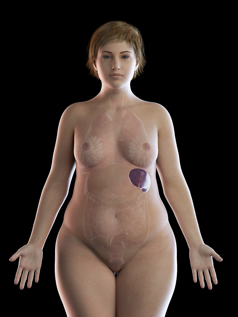 Illustration of an obese woman's spleen