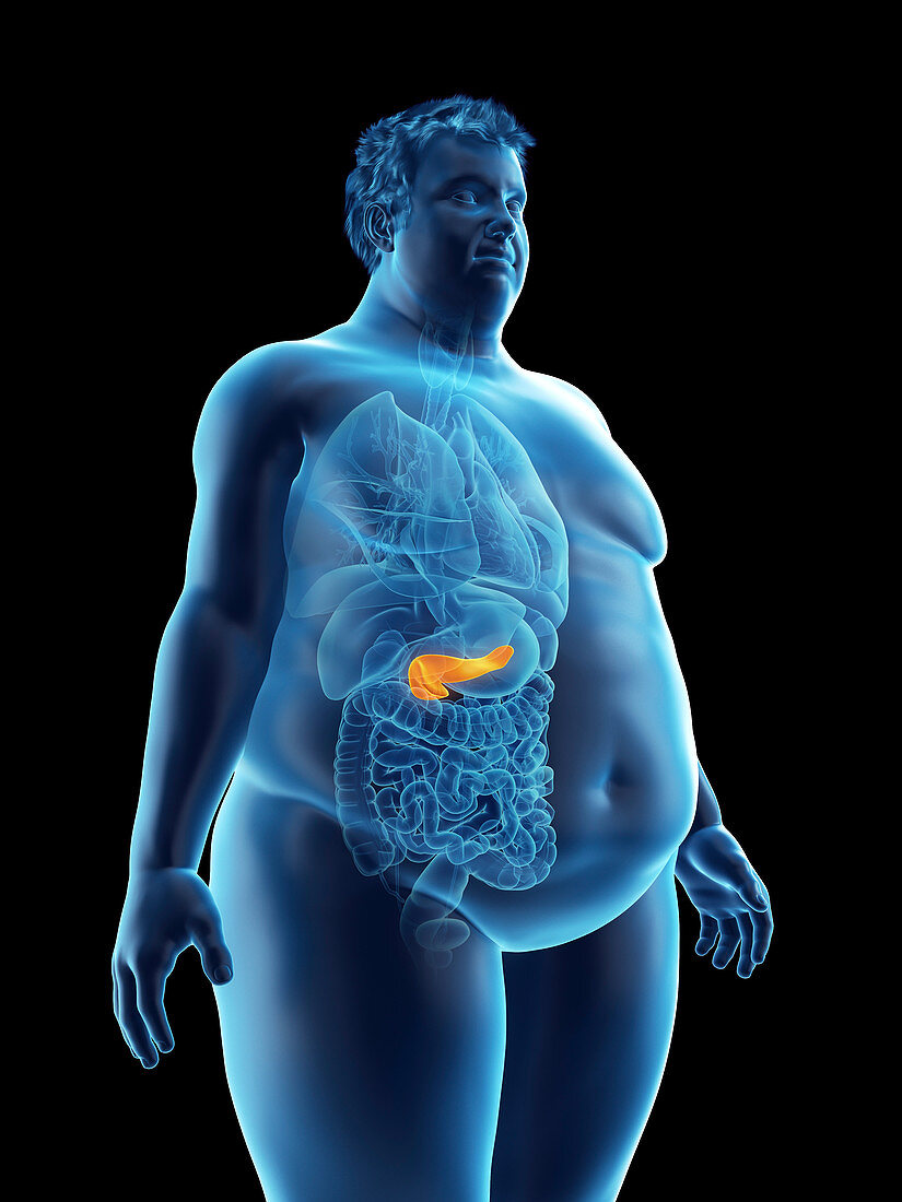 Illustration of an obese man's pancreas