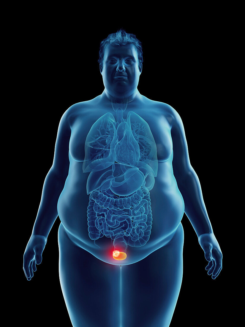 Illustration of an obese man's bladder tumor