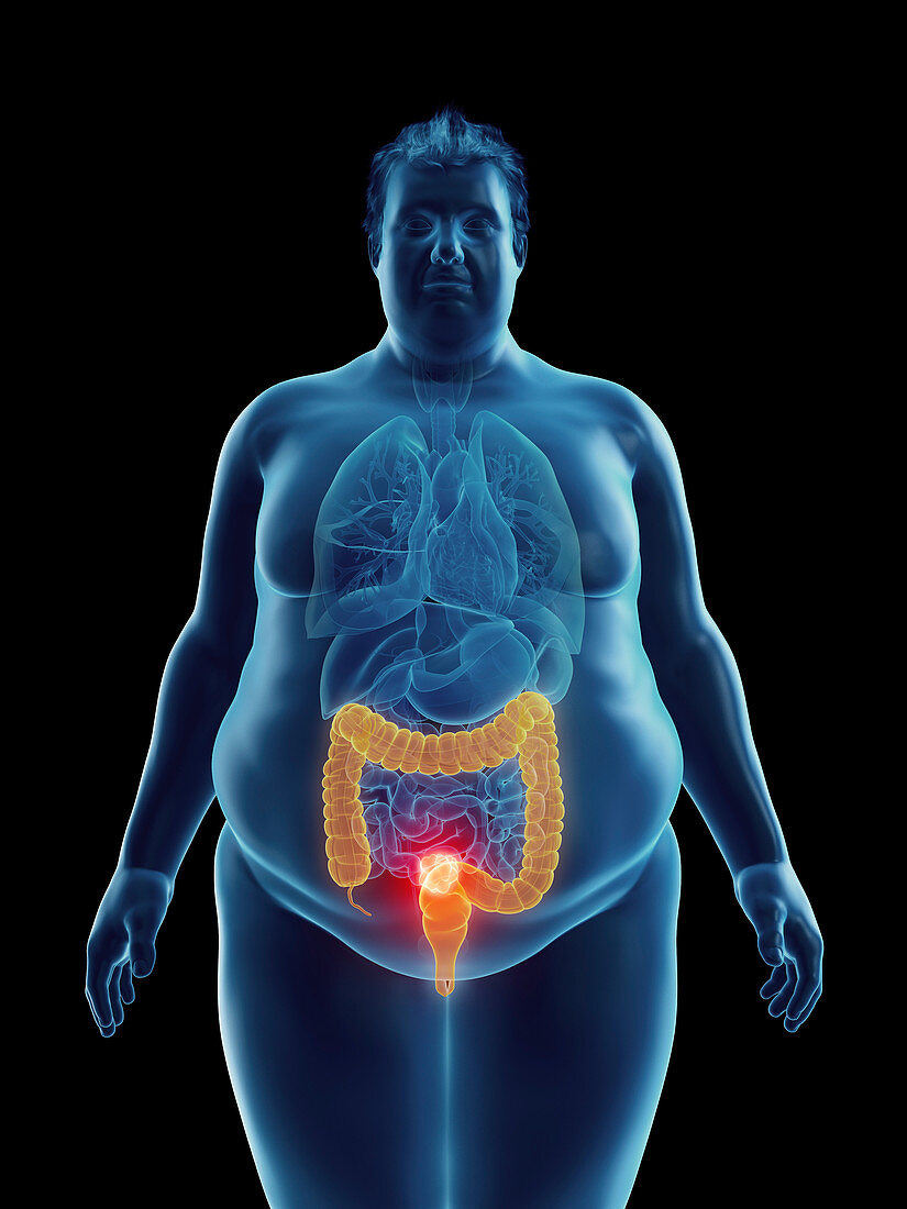 Illustration of an obese man's colon tumor