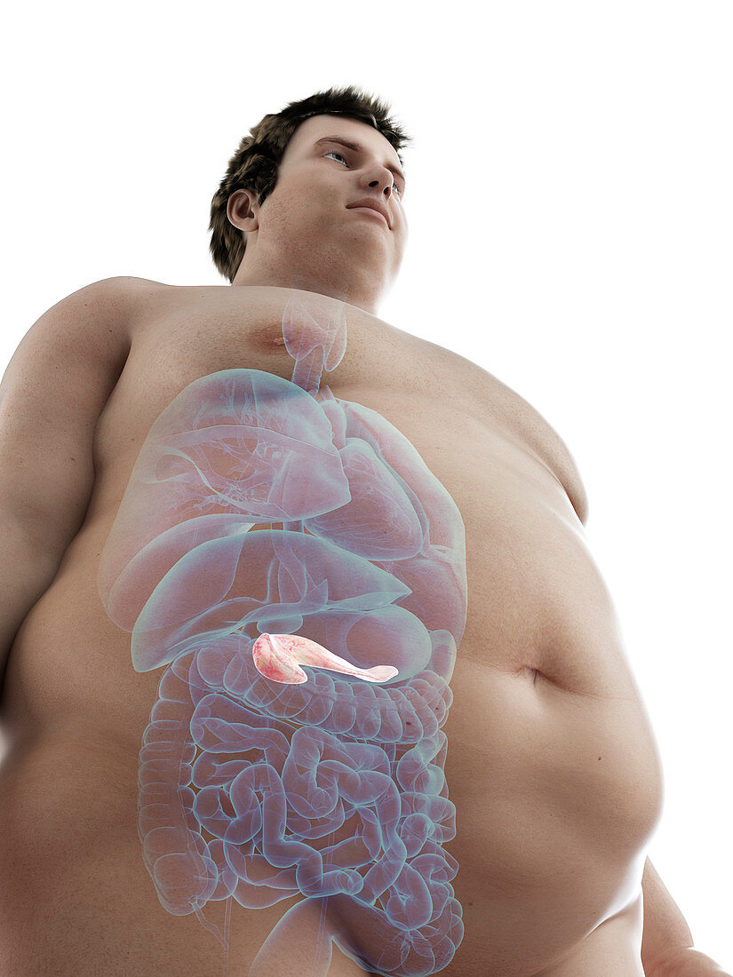 Illustration of an obese man's pancreas