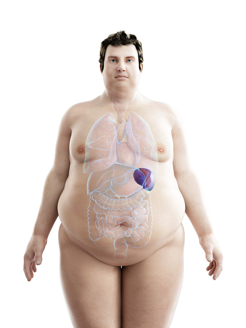 Illustration of an obese man's spleen