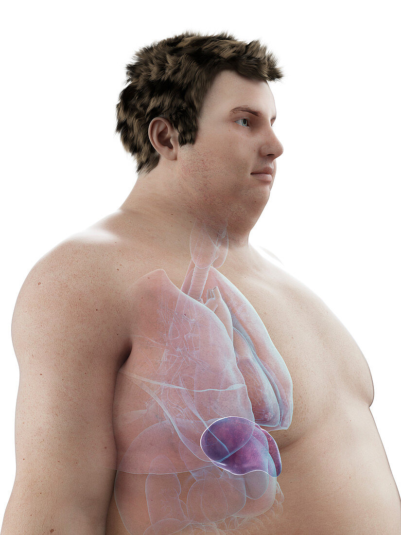 Illustration of an obese man's spleen