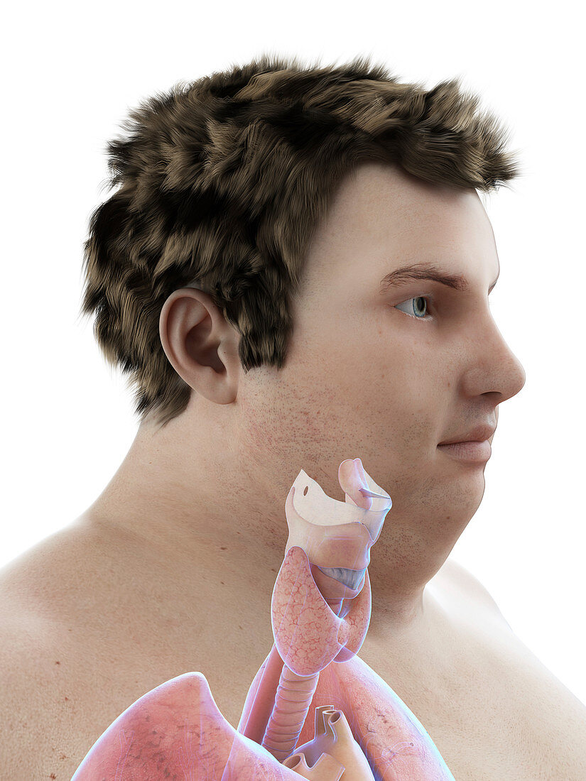 Illustration of an obese man's throat anatomy