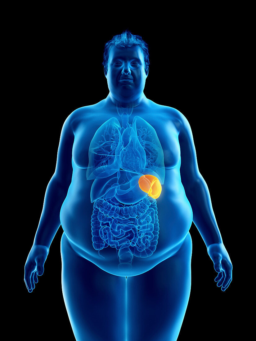 Illustration of an obese man's spleen