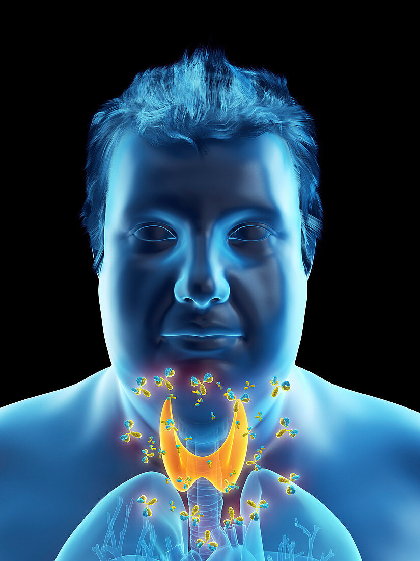 Illustration of an autoimmune thyroid disease