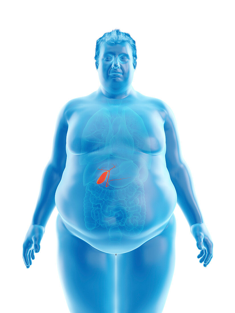 Illustration of an obese man's gallbladder