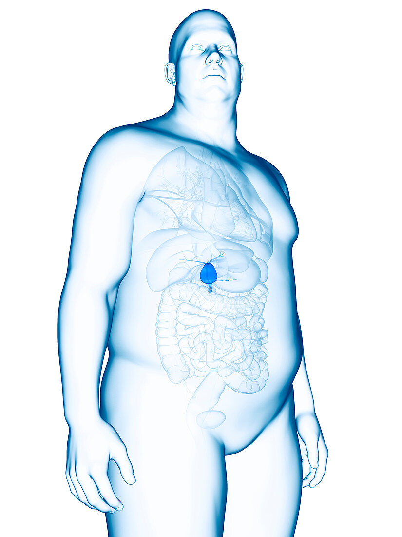 Illustration of an obese man's gallbladder