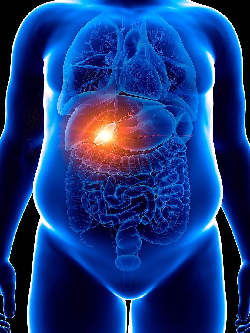 Illustration of an obese man with a painful gallbladder