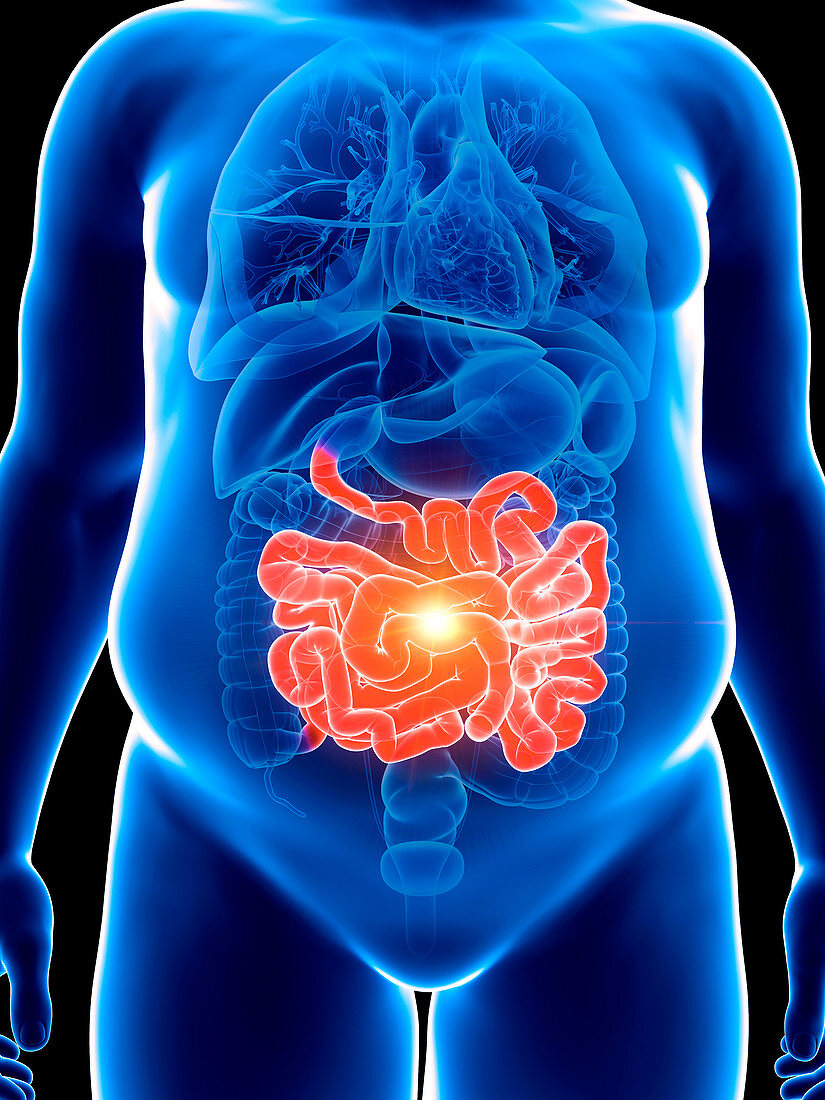 Illustration of an obese man with a painful intestine